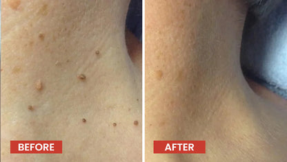 Derma Smooth Tag Remover